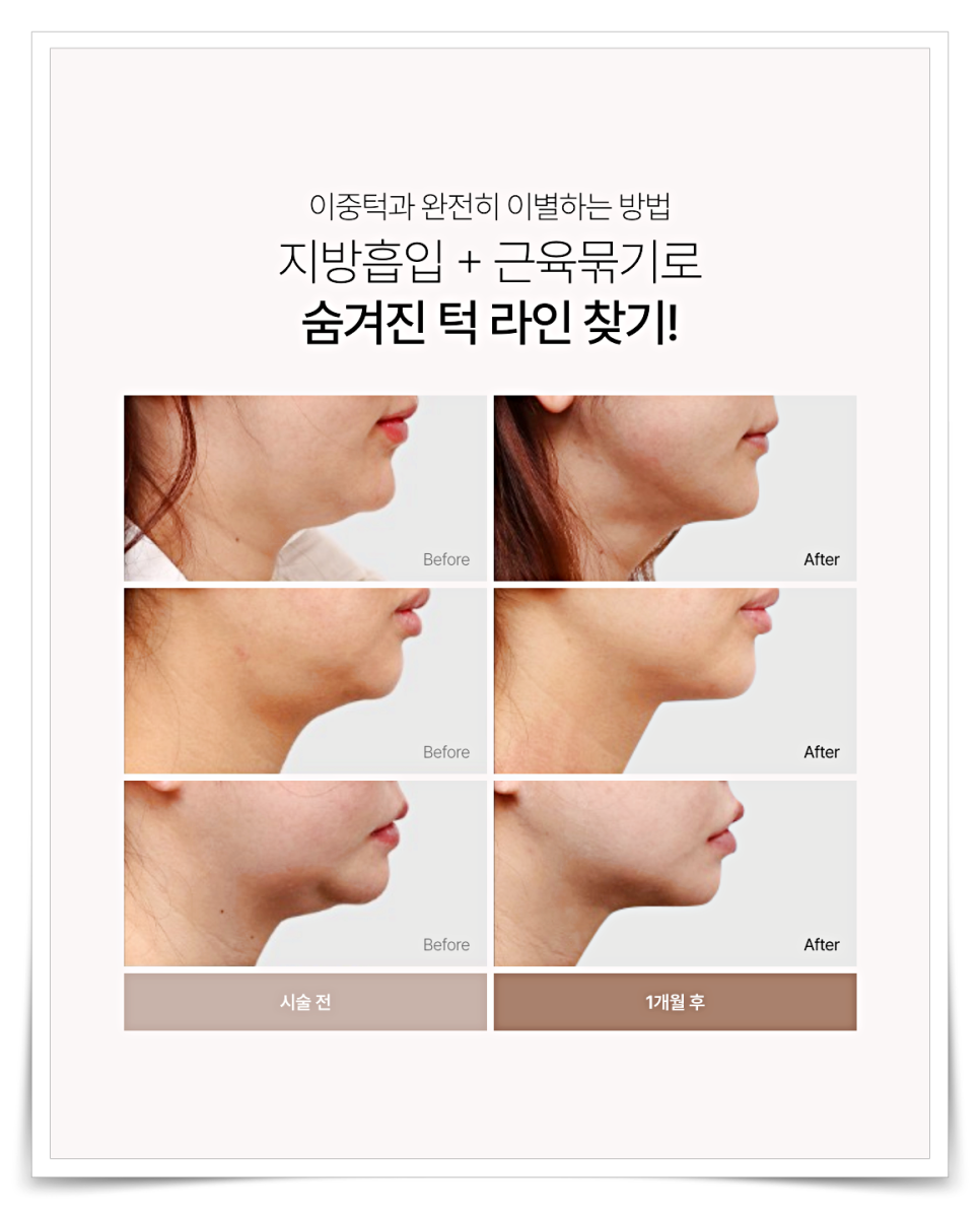 Double Chin Removal Surgery: How to Get Rid of a Double Chin Completely image 8