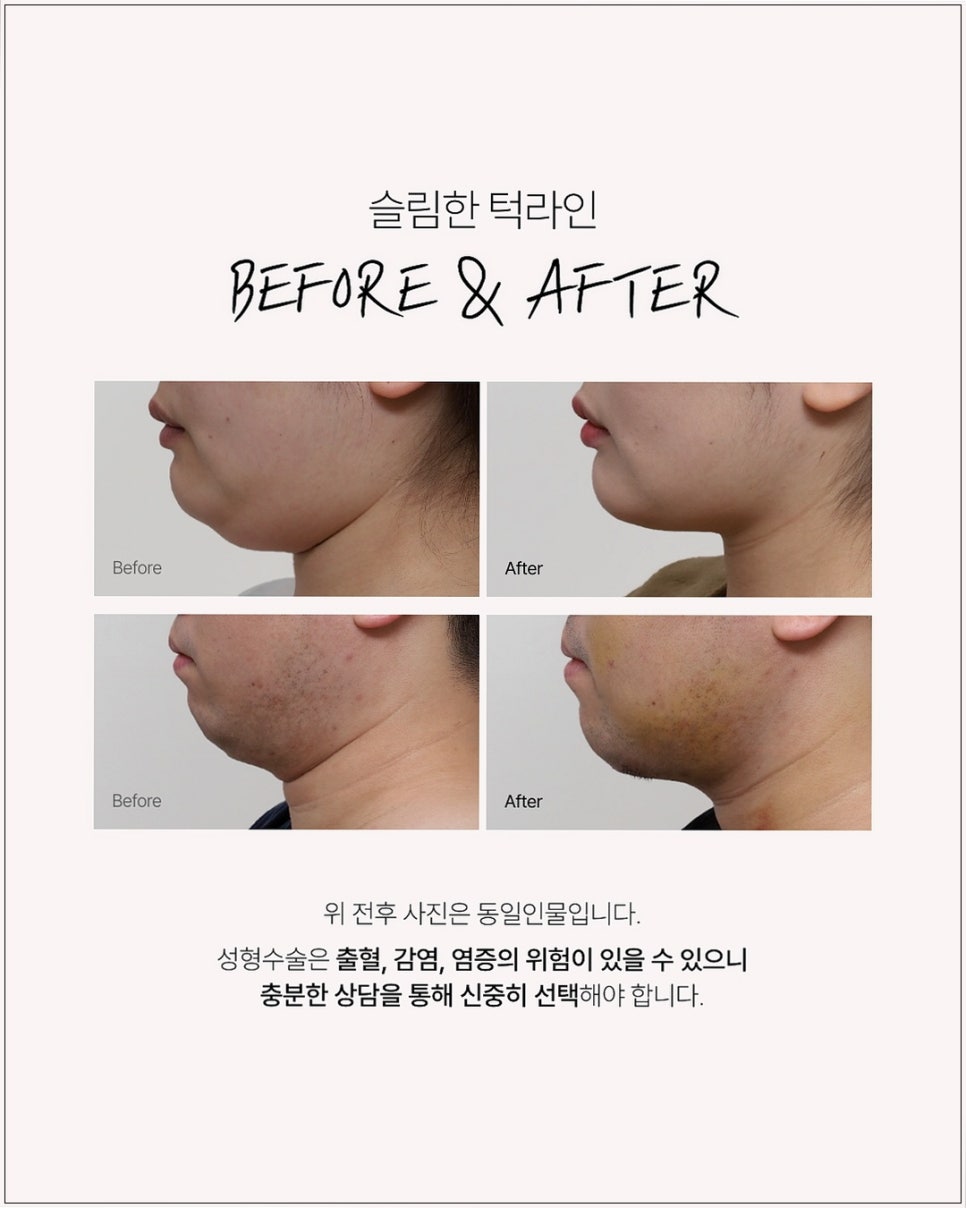 투턱 수술,이중턱 성형의 얼굴 윤곽 개선 효과 관련 이미지 3