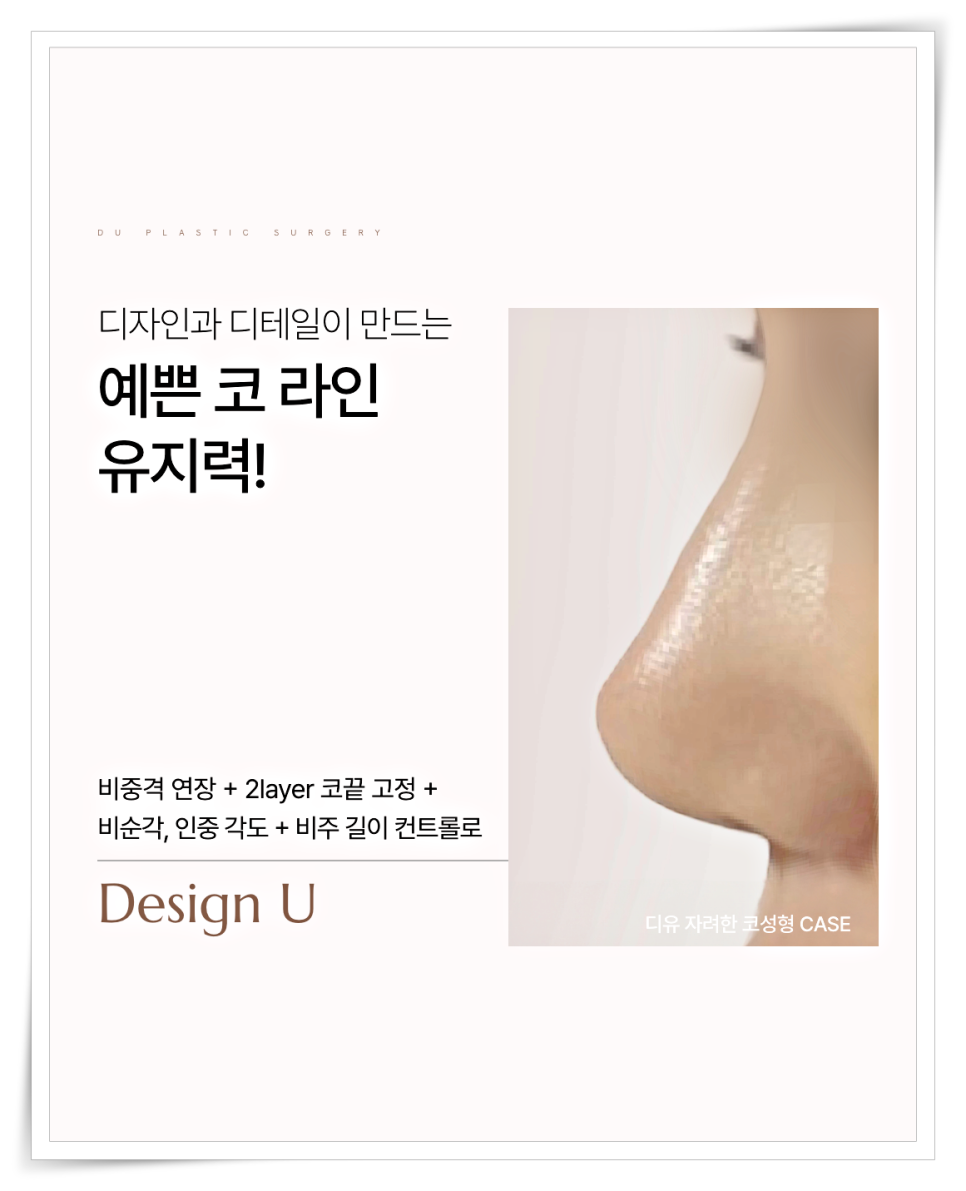 A Design Method to Avoid Failure in Short Nose Revision Surgery image 10