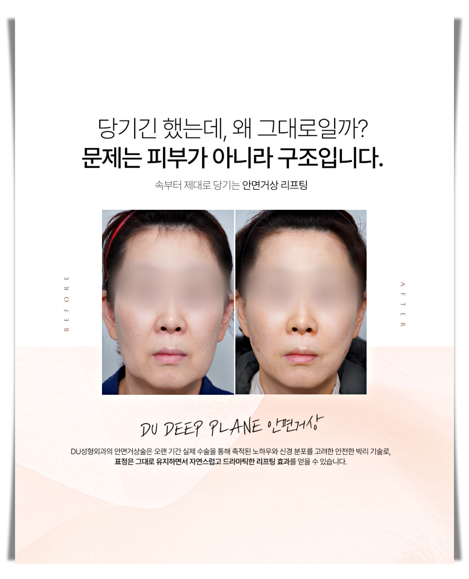 A More Certain Choice Than Mini Thread Lifting: Mini Facelift image 12