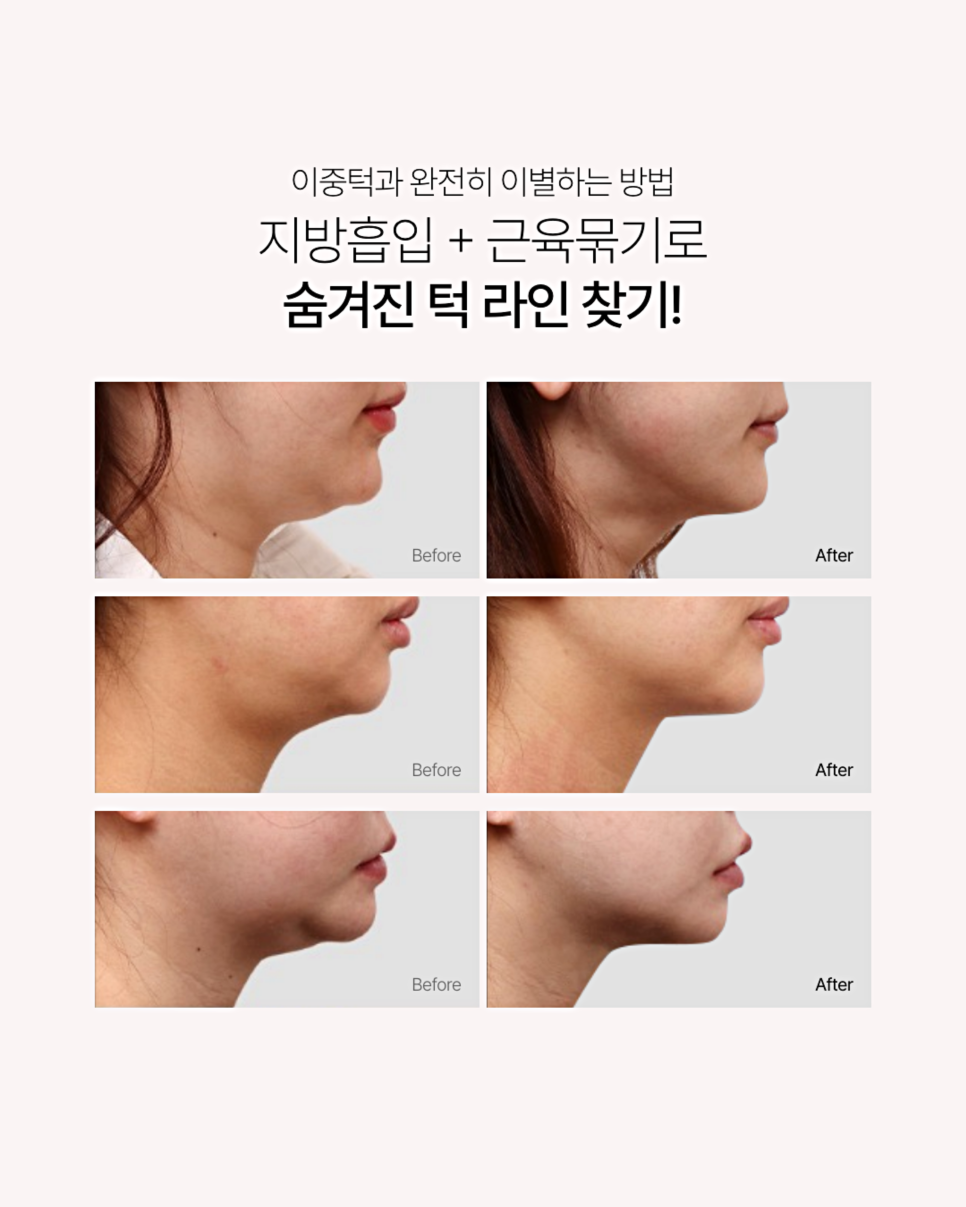 턱살지흡, 케이스 별 알맞은 시술 방향성 추천해드릴게요 관련 이미지 3