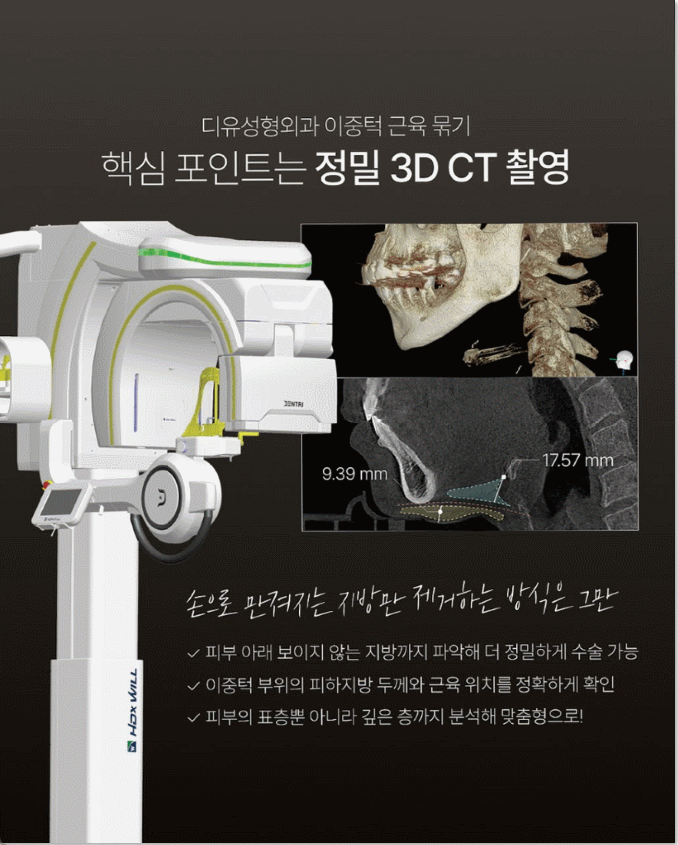 투턱 수술,이중턱 성형의 얼굴 윤곽 개선 효과 관련 이미지 6