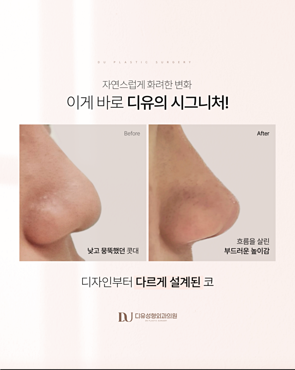 Revision Rhinoplasty Revision Surgery: Why You Should Choose a Plastic Surgery Clinic More Carefully Than for the First Surgery image 3
