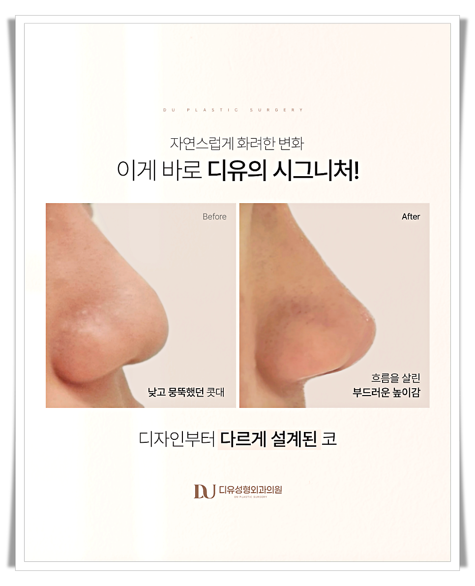 코끝처짐 원인과 교정 방법 관련 이미지 15