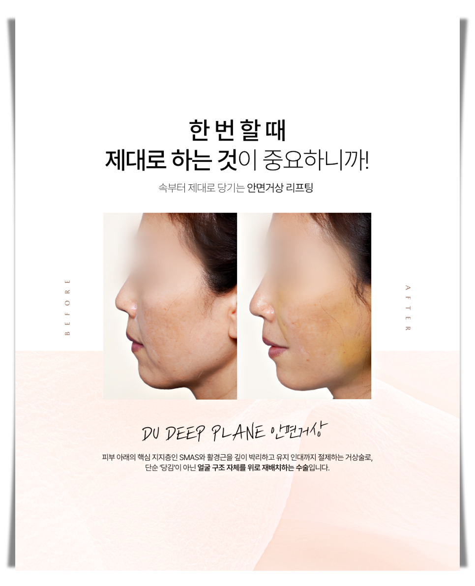 A More Certain Choice Than Mini Thread Lifting: Mini Facelift image 13