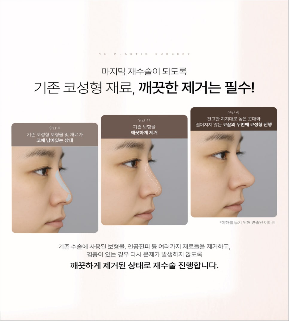 Nose Filler Migration: What You Must Know If You’re Considering Nose Surgery image 6