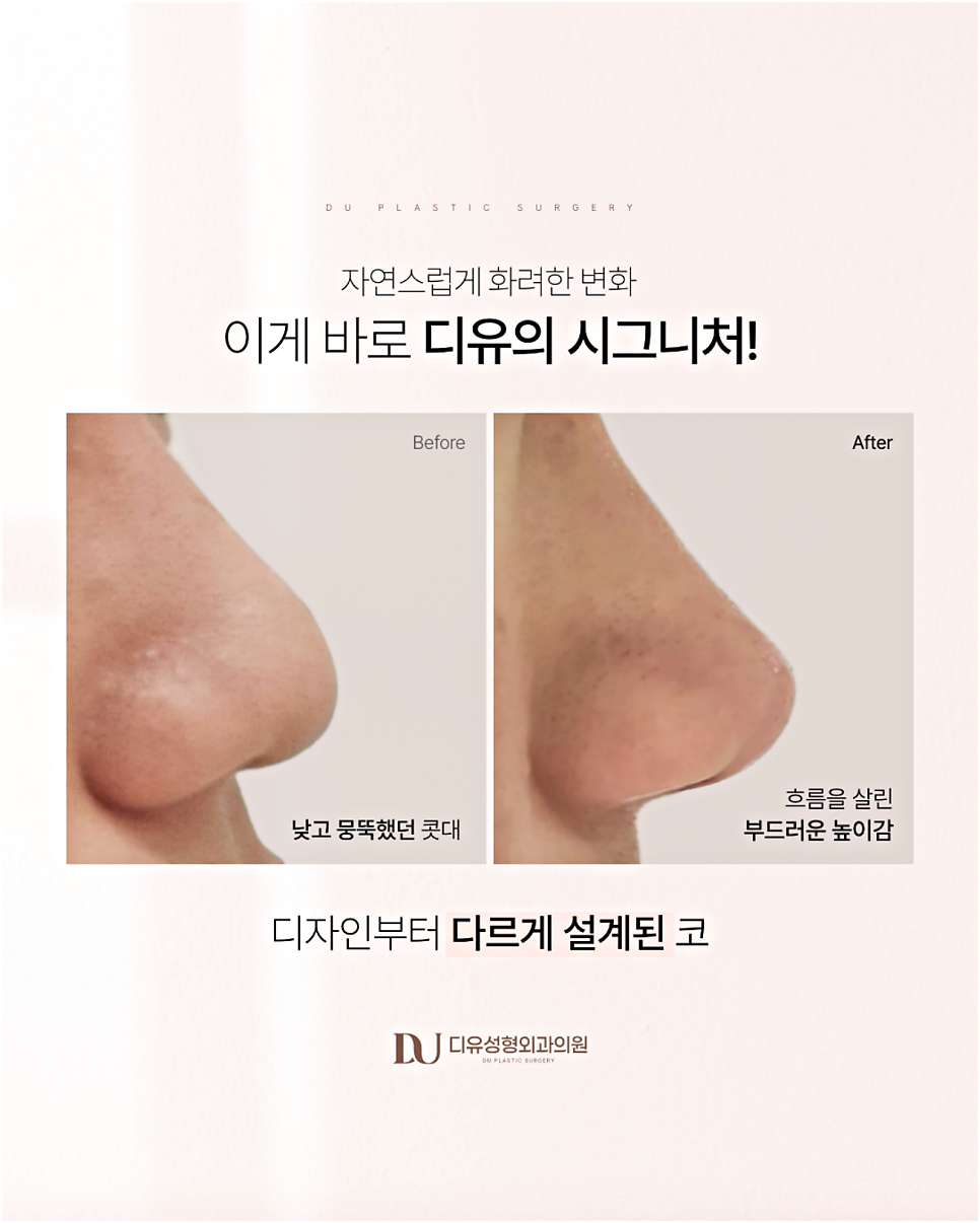 늑연골코수술부작용이 걱정되시는 분들은 읽어보세요 관련 이미지 8