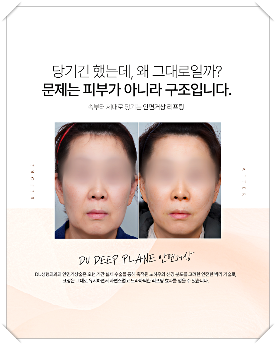 미니거상흉터 최소화, 자연스러운 리프팅을 위한 전략 관련 이미지 11