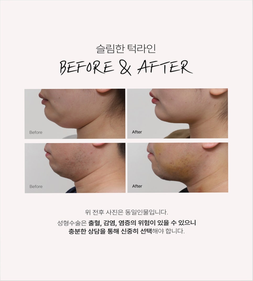 Why Double Chin Surgery Should Be Done at a Trusted Clinic image 2