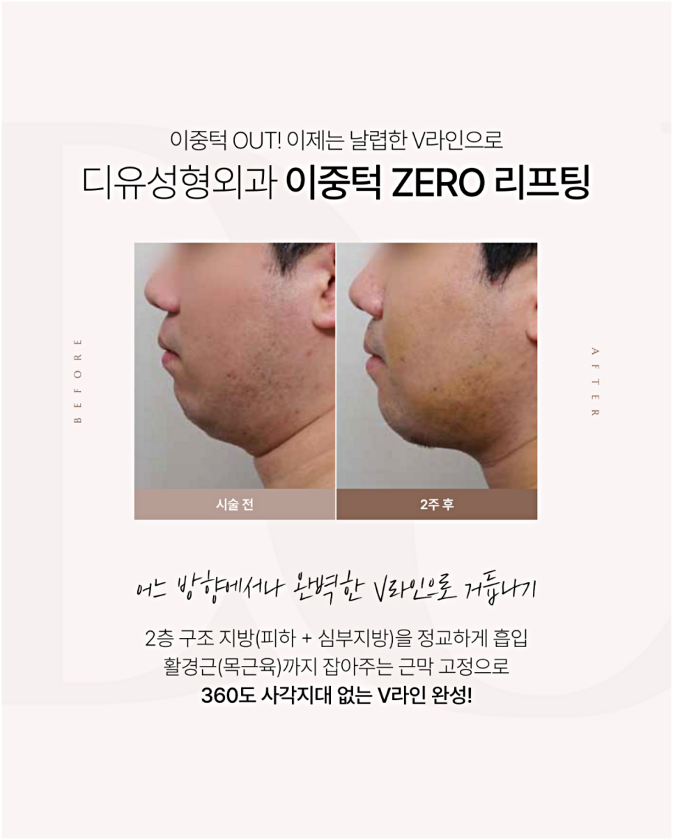 If you're worried about swelling after double chin muscle tightening, read this image 2