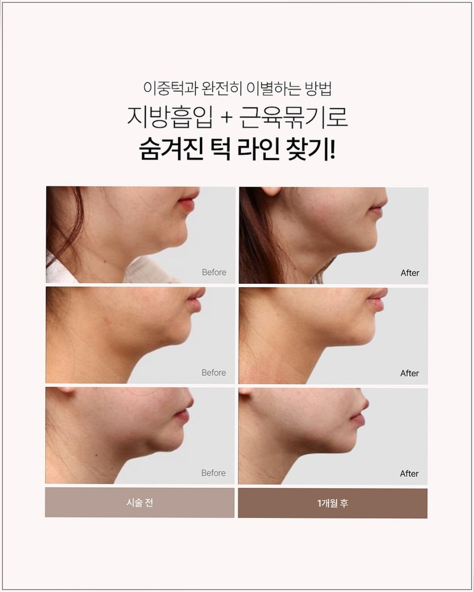 투턱 보톡스 맞았는데 변화가 없으신 분들은 꼭 읽어보세요 관련 이미지 3