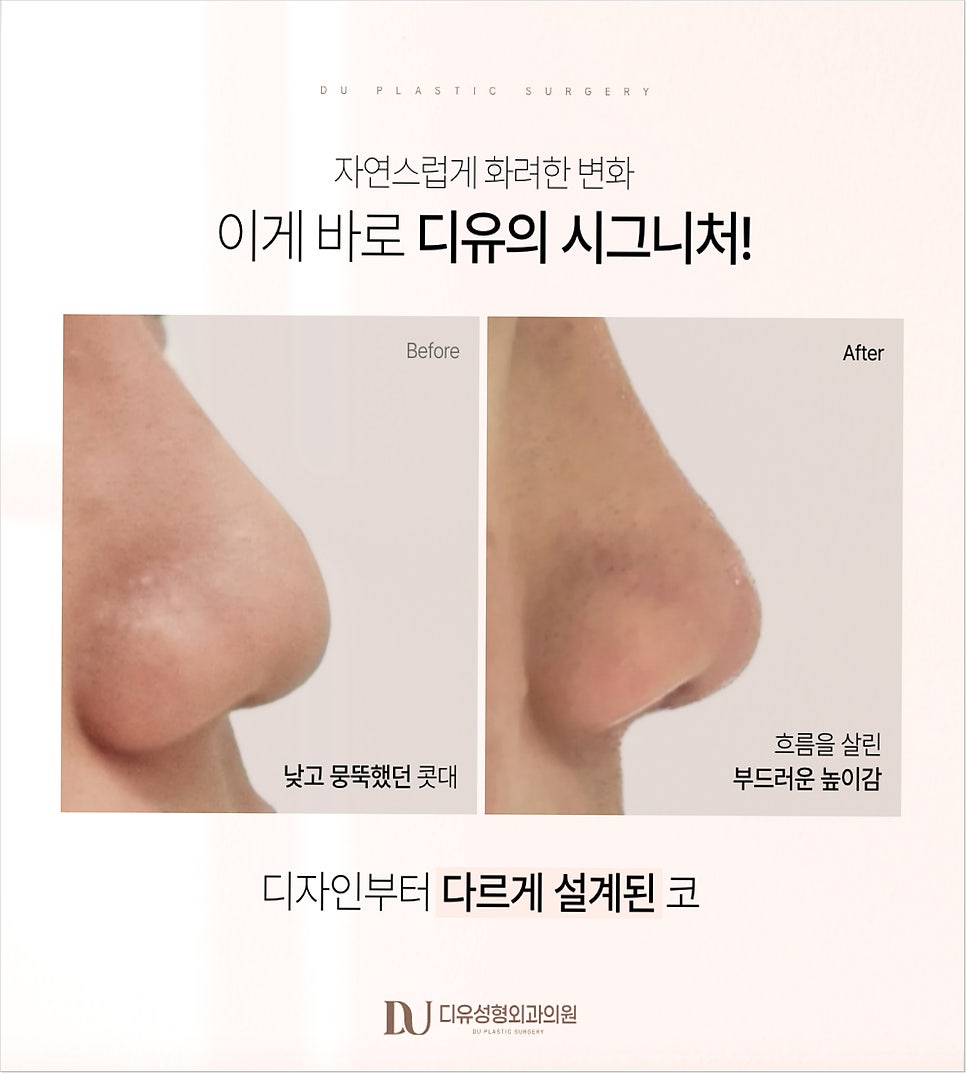 늑연골 코성형, 선택해야 하는 진짜 이유는? 관련 이미지 4