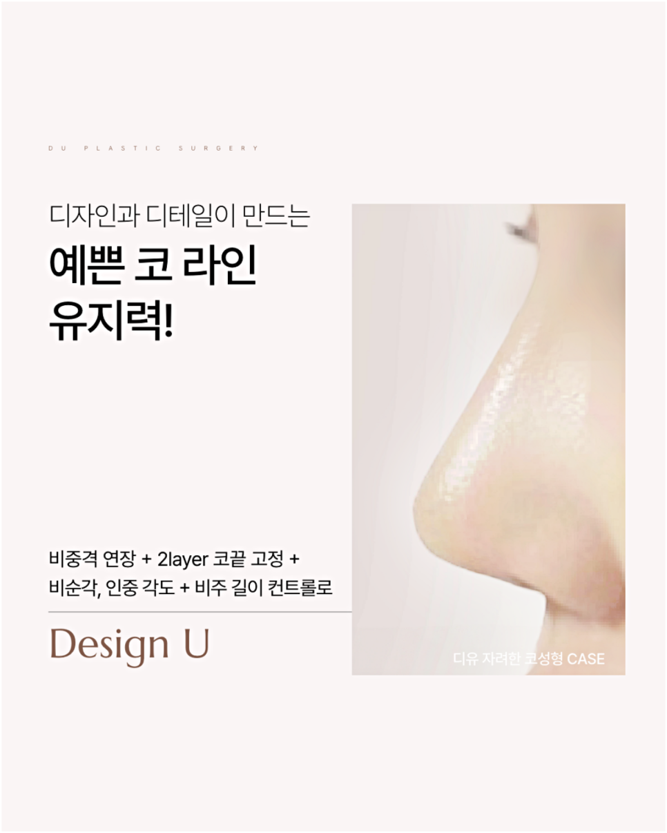 매부리코재수술 더 신중하게 결정해야 하는 이유 관련 이미지 7