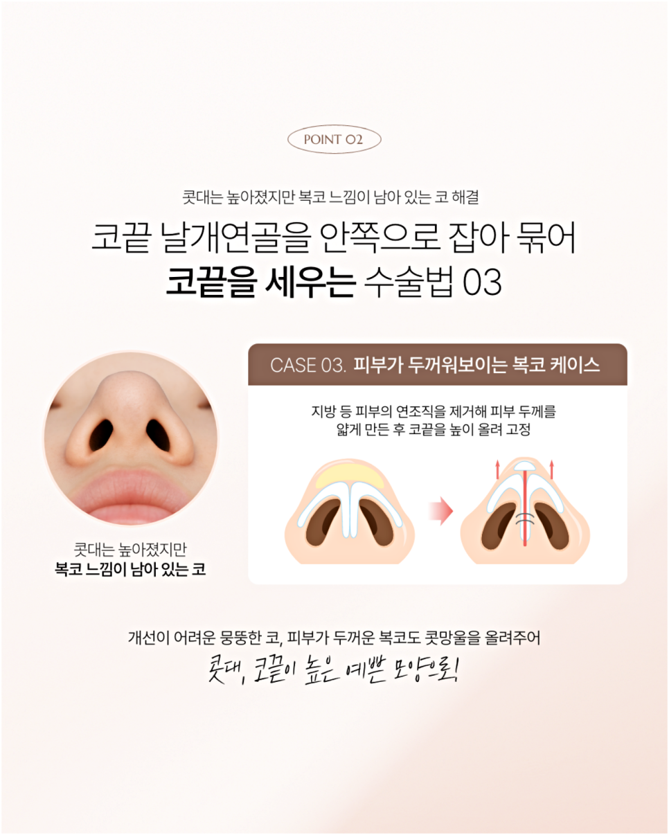 늑연골코수술부작용이 걱정되시는 분들은 읽어보세요 관련 이미지 5
