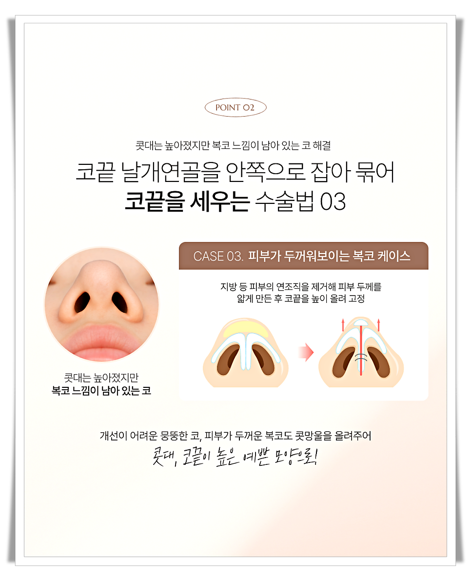 코끝처짐 원인과 교정 방법 관련 이미지 9
