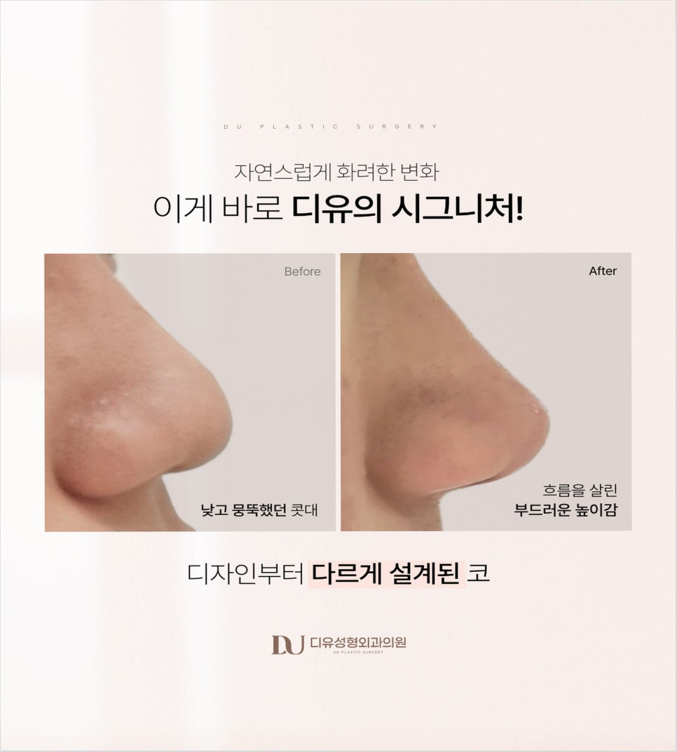 Nose Filler Migration: What You Must Know If You’re Considering Nose Surgery image 4