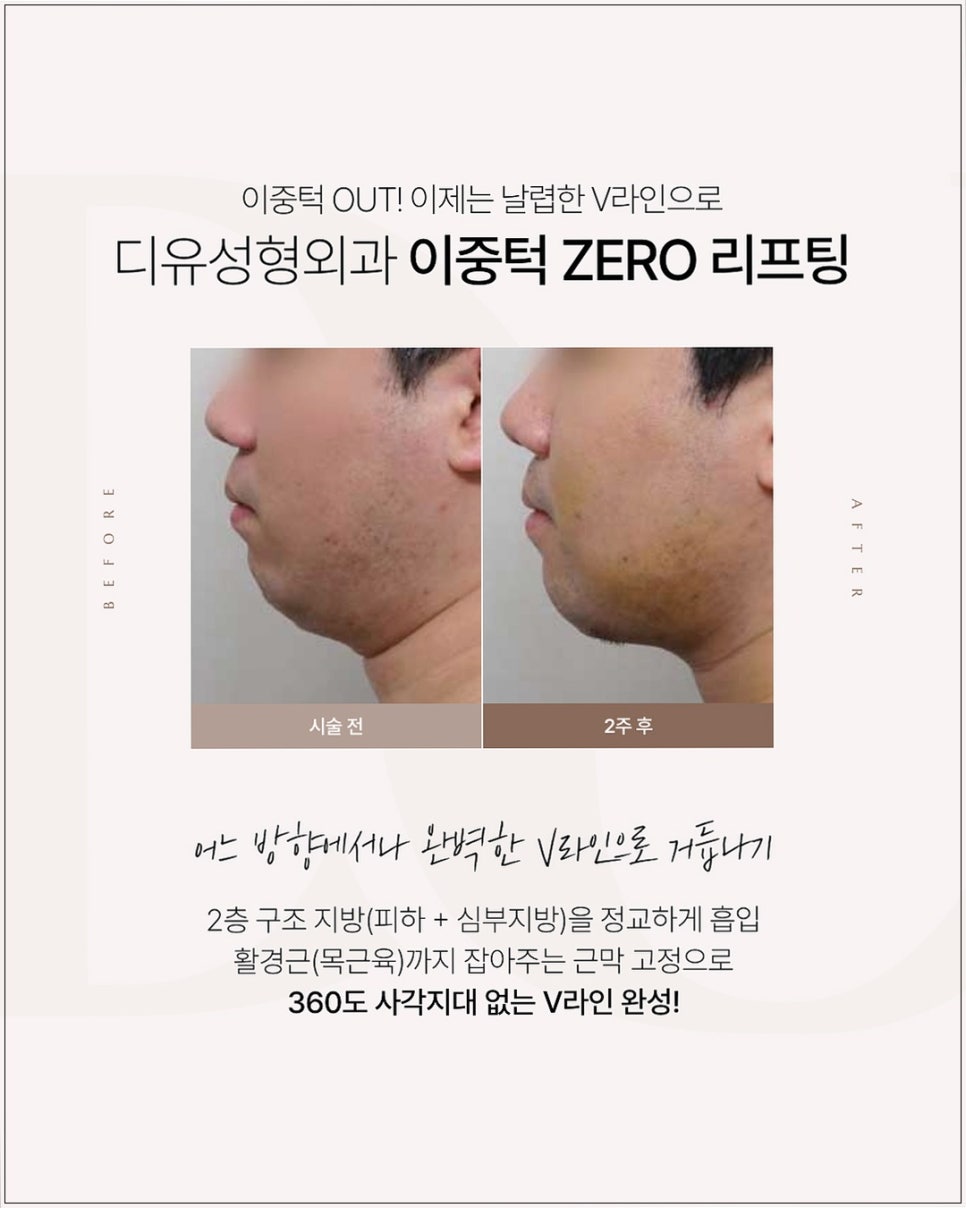 투턱 보톡스 맞았는데 변화가 없으신 분들은 꼭 읽어보세요 관련 이미지 5