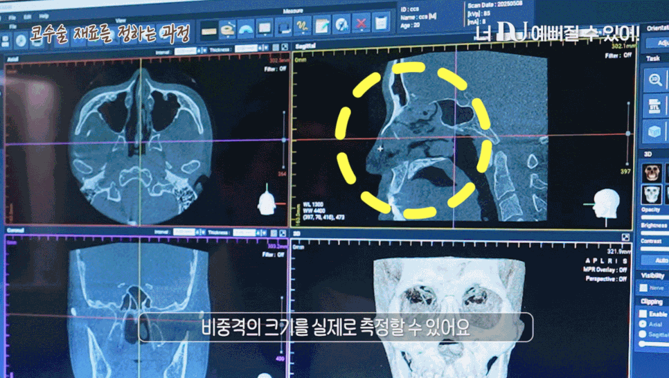 코재건 다시 또 수술하지 않으려면 꼭 알아야 할 한 가지 관련 이미지 7