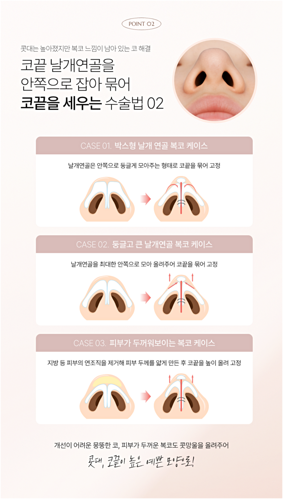 매부리코재수술 더 신중하게 결정해야 하는 이유 관련 이미지 4