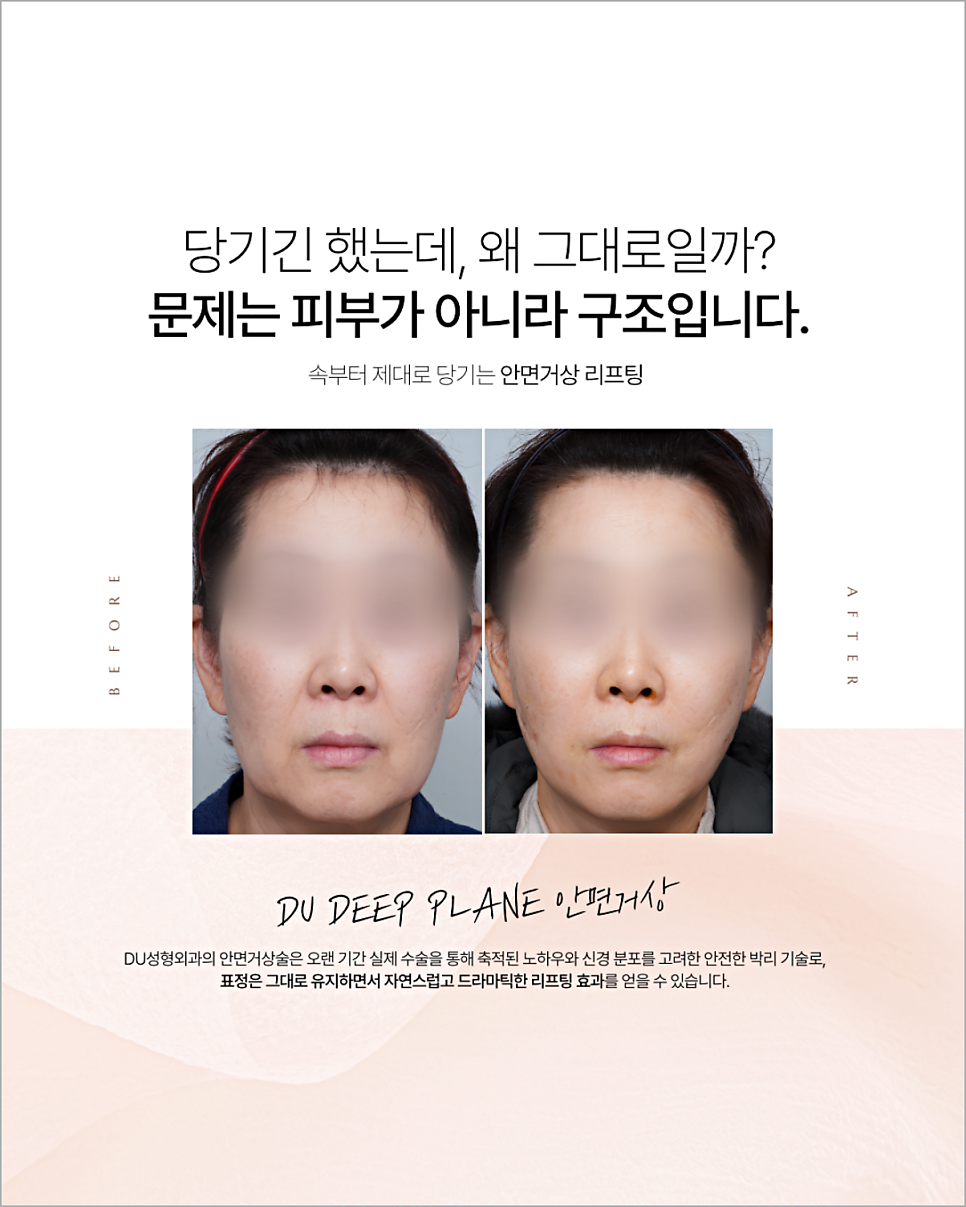 스마스미니거상 비슷해 보여도 방법과 결과가 다릅니다 관련 이미지 6
