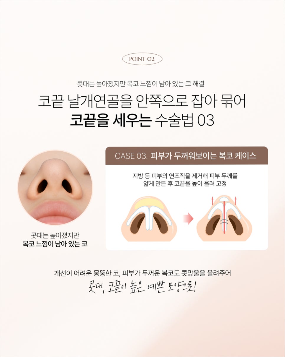 비주빼기,자려한 코 성형을 고려 중이신 분들 꼭 확인해 보세요. 관련 이미지 5