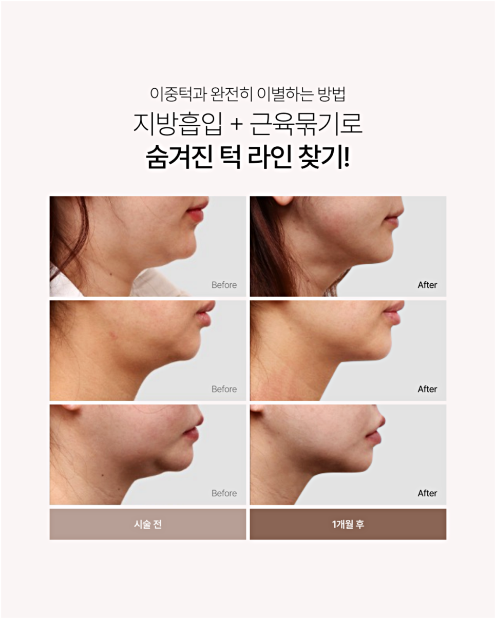 Double Chin Muscle Surgery: Why Liposuction Alone Doesn’t Solve the Contour image 2