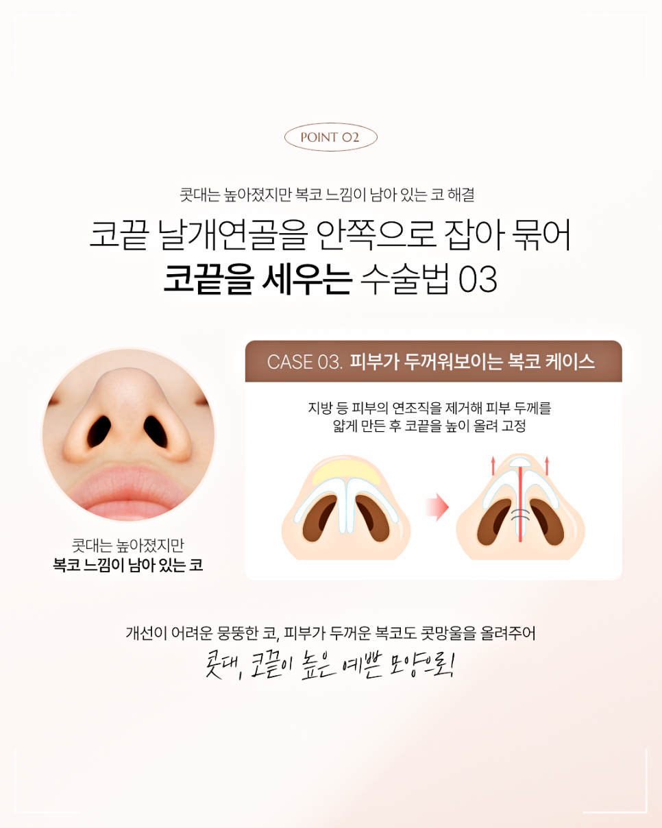 짧은코 재수술, 해결하려면 구조부터 봐야 합니다 관련 이미지 8