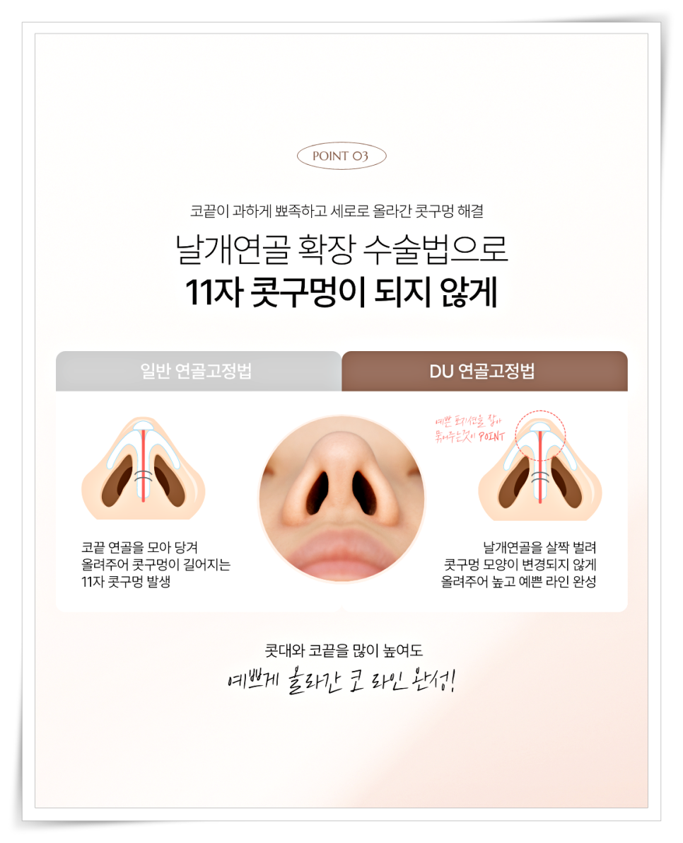 A Design Method to Avoid Failure in Short Nose Revision Surgery image 7