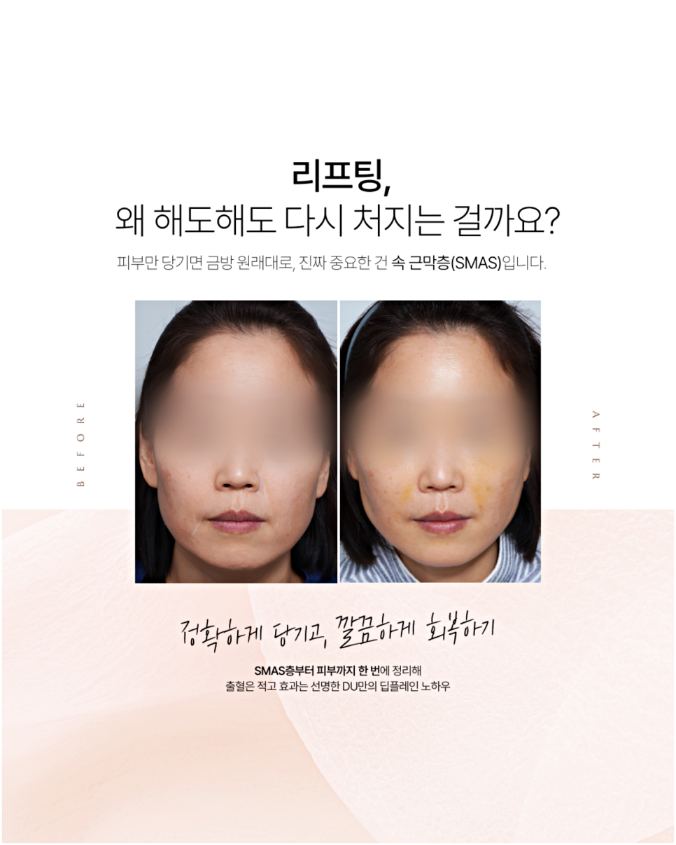 Seoul facelift results vary depending on where you get the procedure. image 7