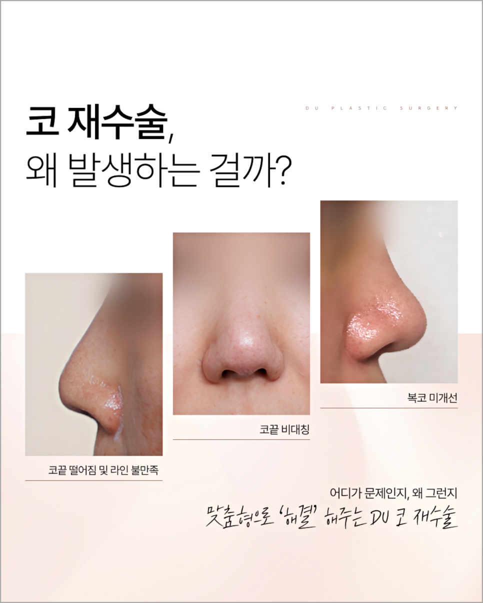Are You Still Debating Short Nose Revision Surgery? image 2