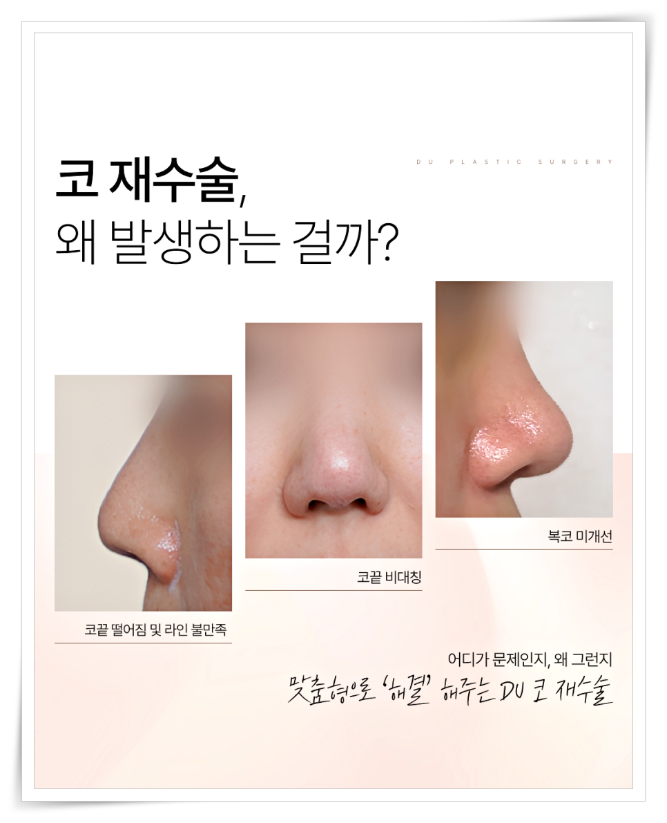 A Design Method to Avoid Failure in Short Nose Revision Surgery image 11
