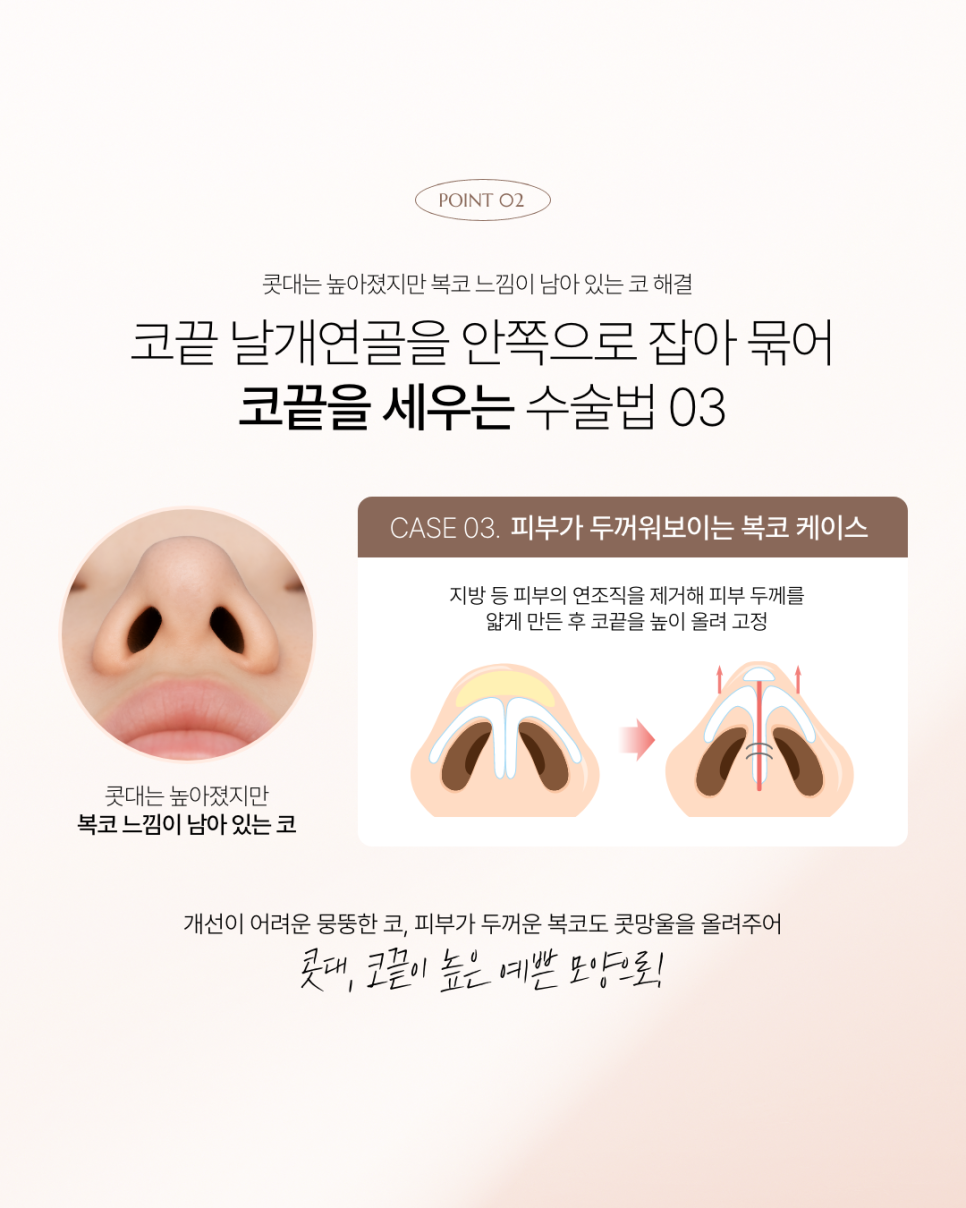 How to Prevent Nasal Tip Drooping image 9