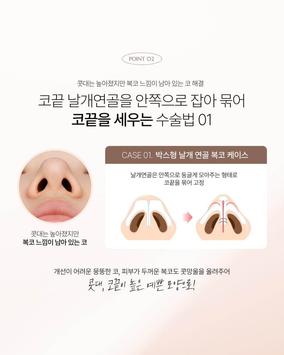 How to Prevent Nasal Tip Drooping image 7