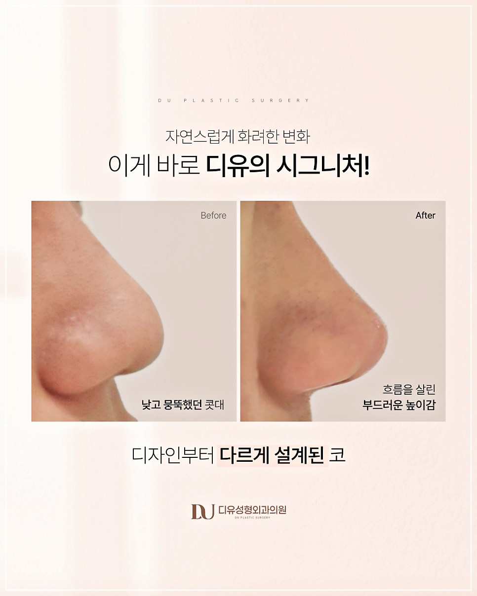 코끝필러퍼짐, 왜 생기고 어떻게 해결할까? 관련 이미지 8