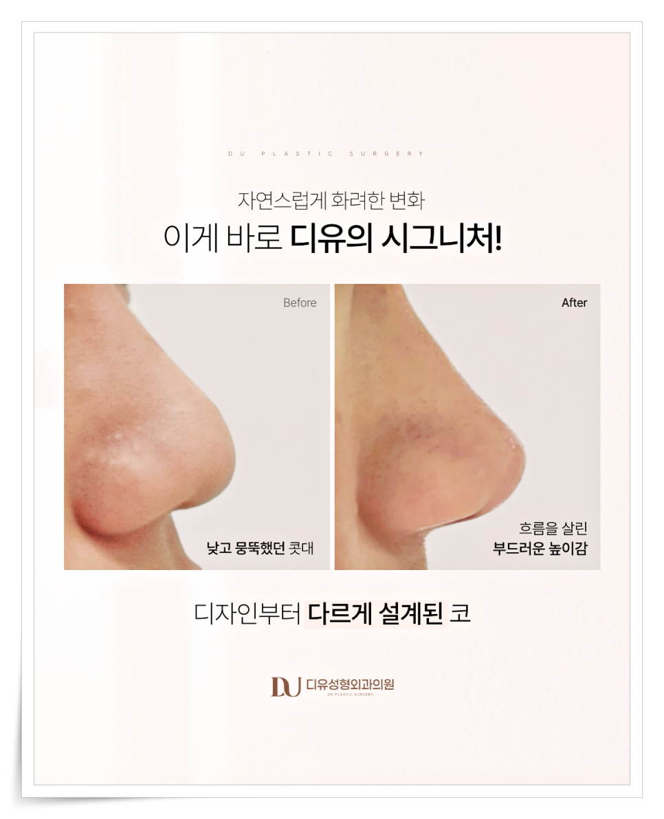 짧은코 재수술, 해결하려면 구조부터 봐야 합니다 관련 이미지 3
