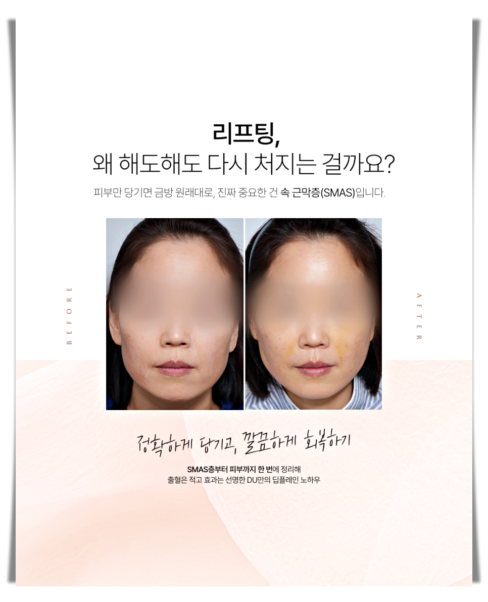 A More Certain Choice Than Mini Thread Lifting: Mini Facelift image 11