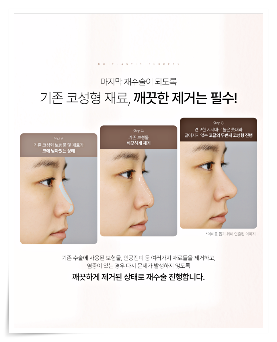 짧은코 재수술, 해결하려면 구조부터 봐야 합니다 관련 이미지 10