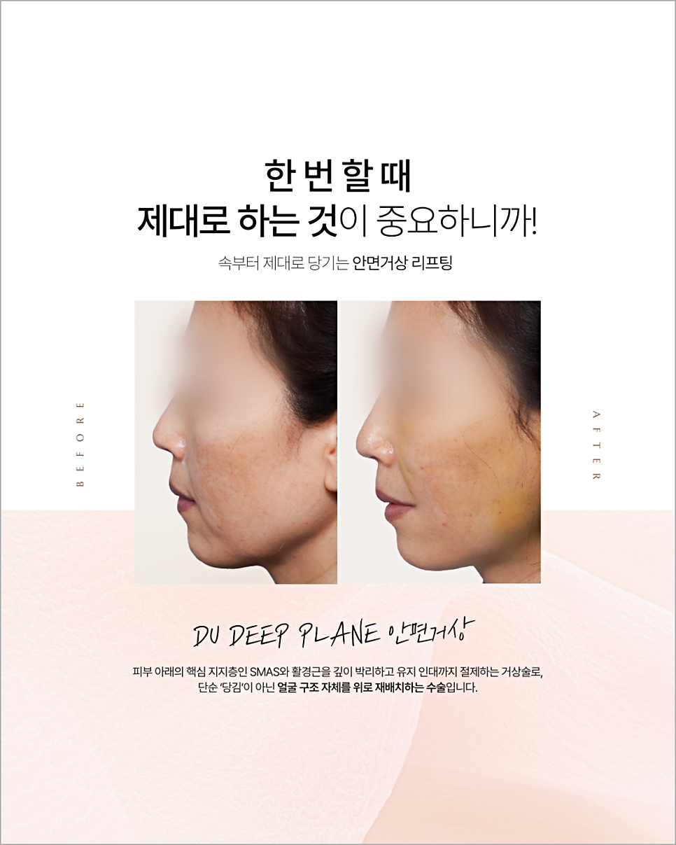 스마스미니거상 비슷해 보여도 방법과 결과가 다릅니다 관련 이미지 7