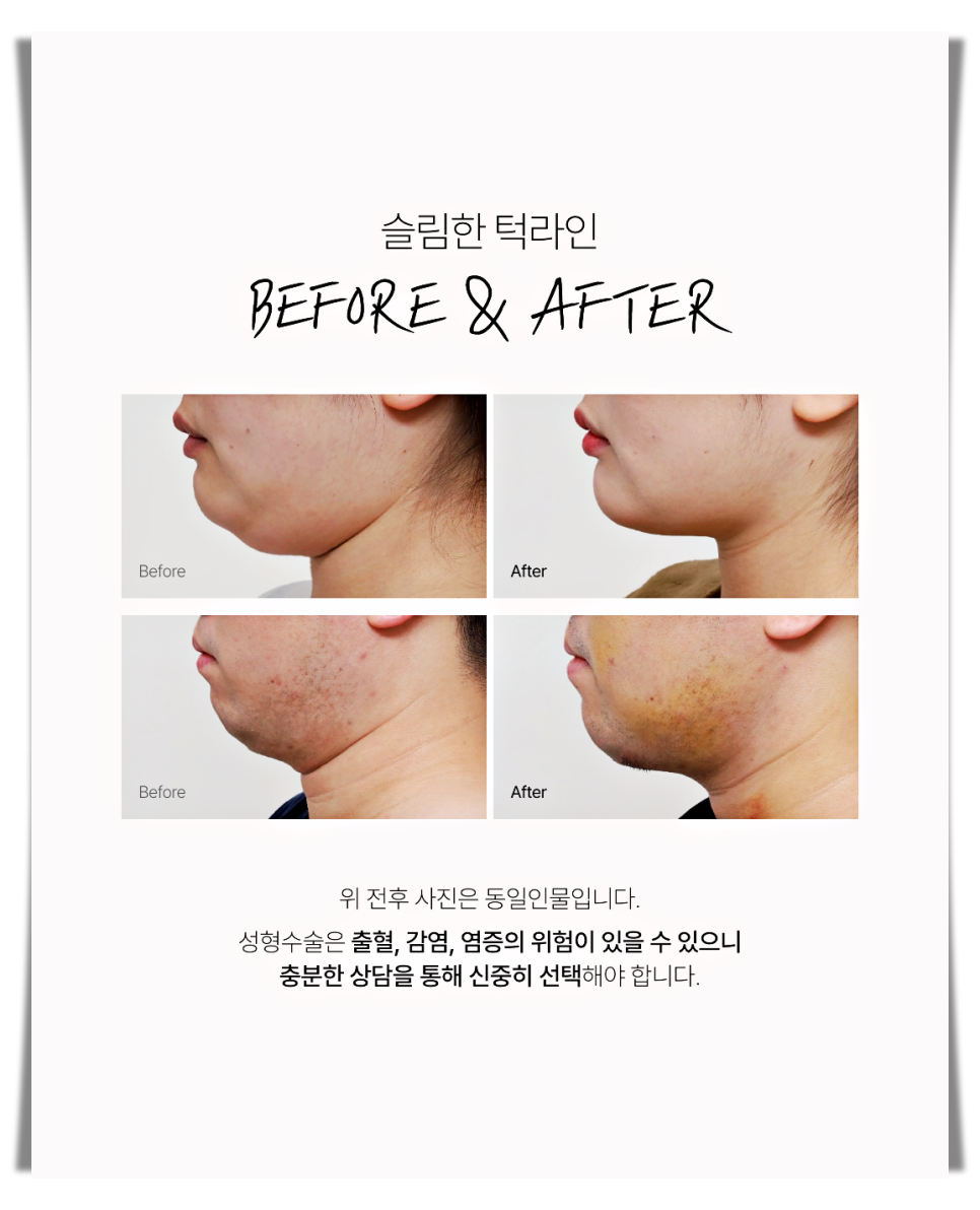 How Can You Get Double Chin Muscle Tightening Safely Without Side Effects? image 5