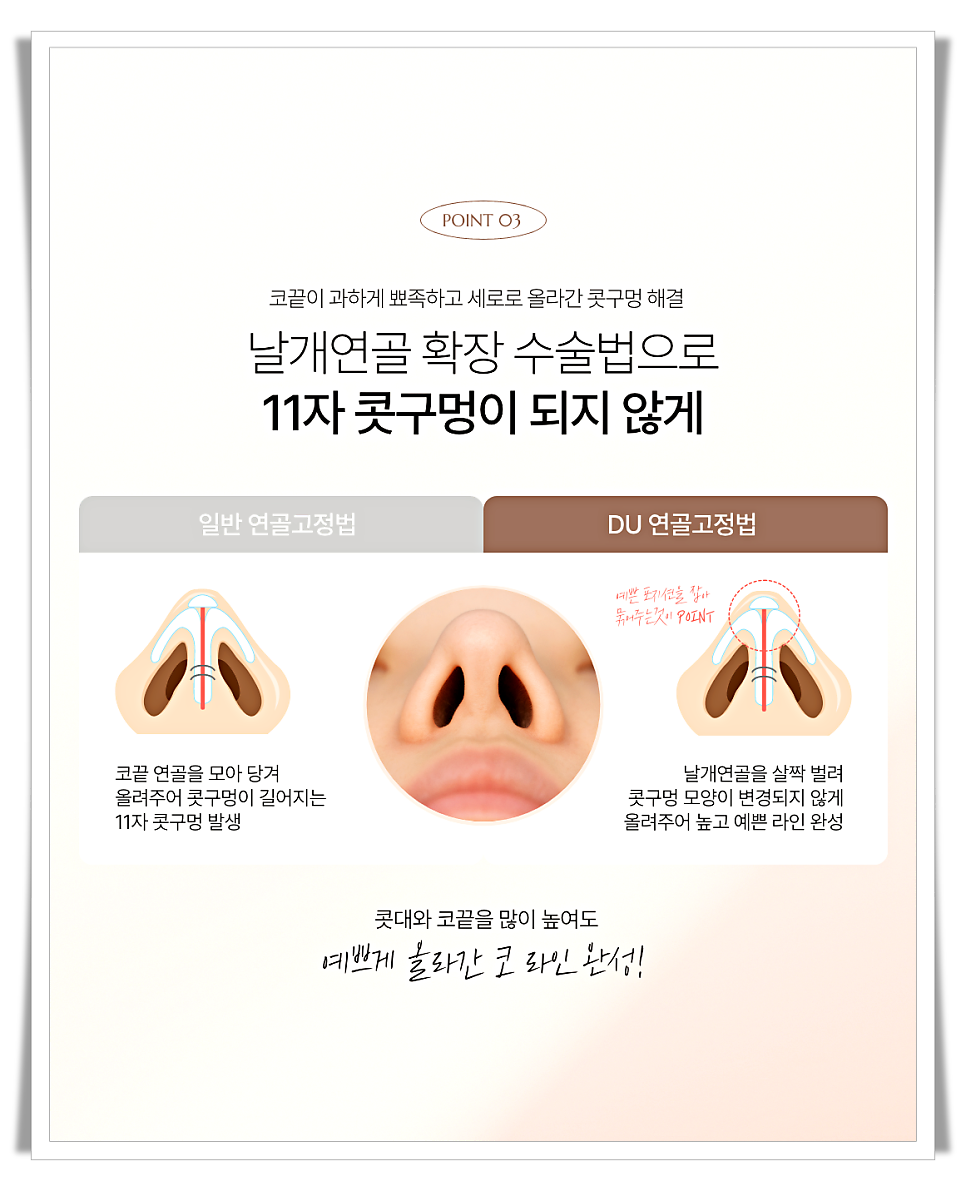 코끝처짐 원인과 교정 방법 관련 이미지 10