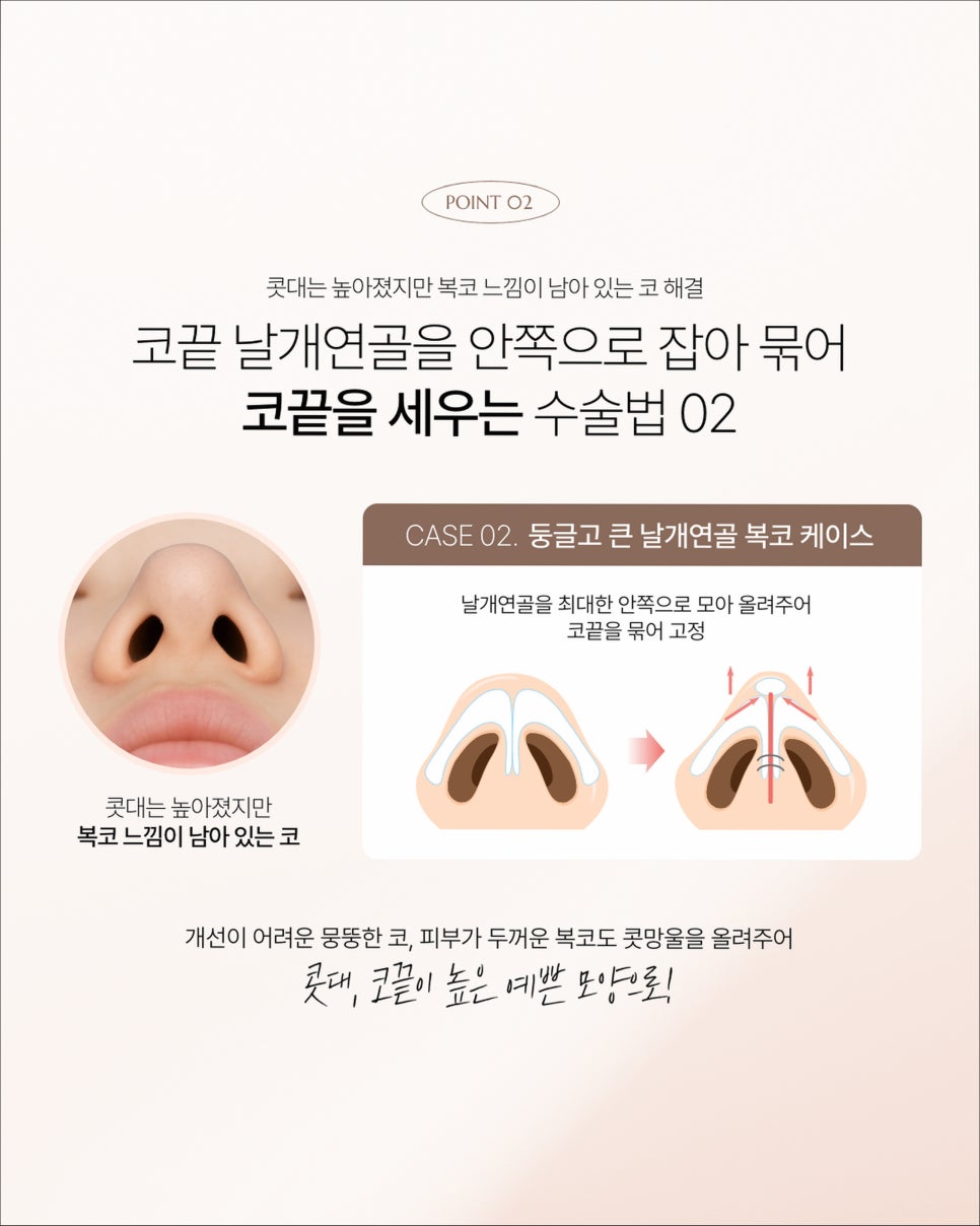 비주빼기,자려한 코 성형을 고려 중이신 분들 꼭 확인해 보세요. 관련 이미지 4
