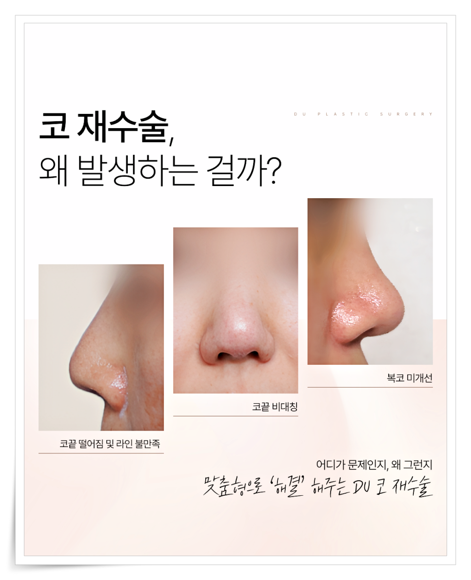짧은코 재수술, 해결하려면 구조부터 봐야 합니다 관련 이미지 9