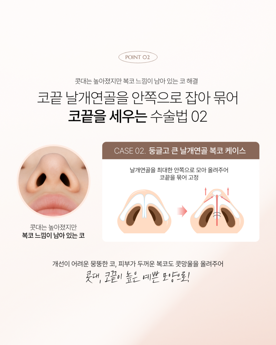 How to Prevent Nasal Tip Drooping image 8