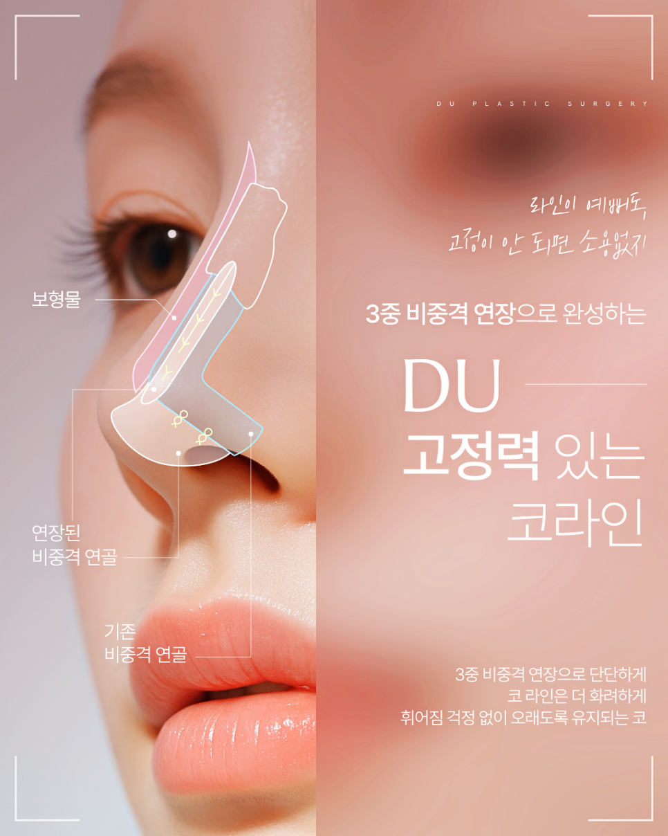 짧은코 재수술, 해결하려면 구조부터 봐야 합니다 관련 이미지 16