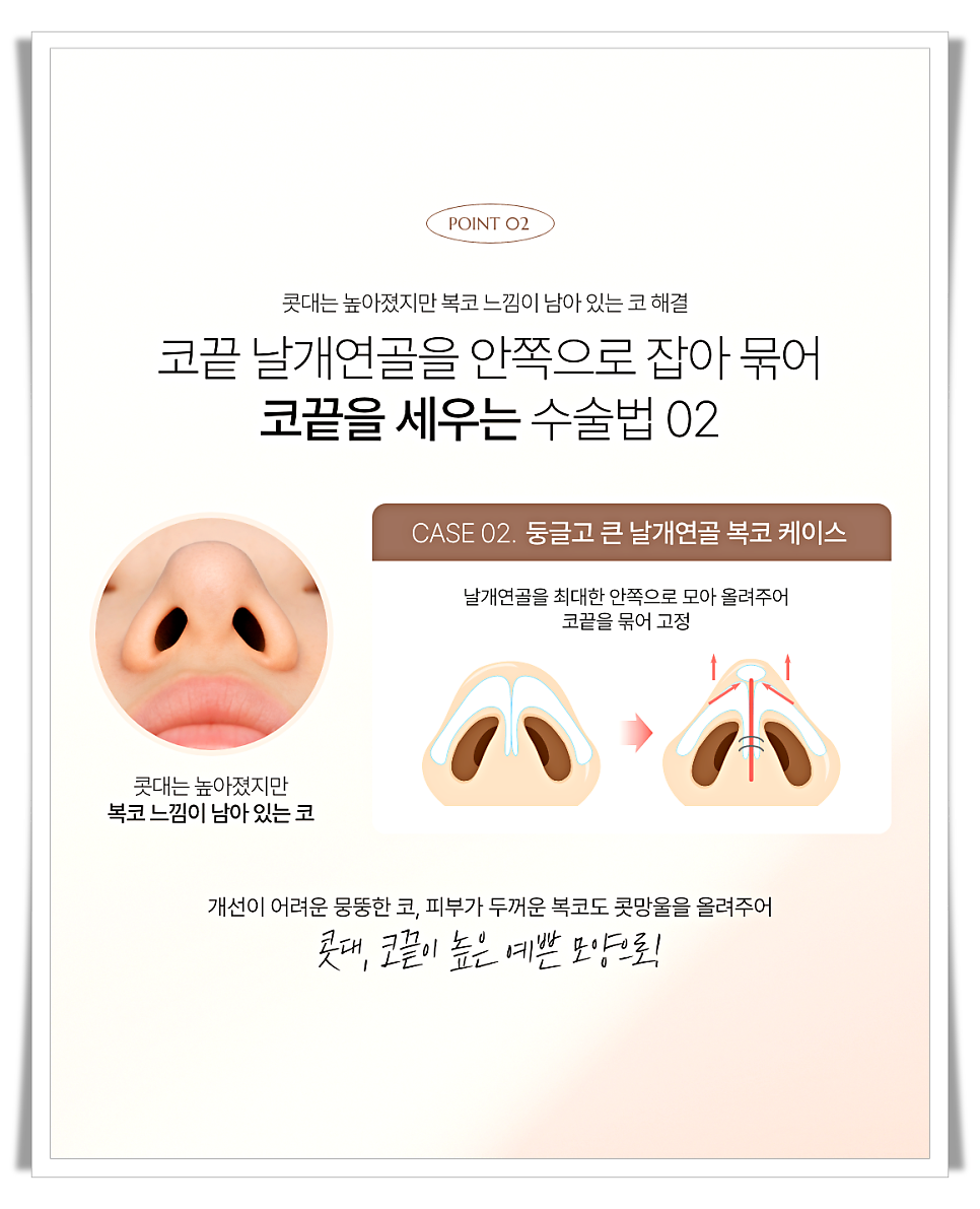 코끝처짐 원인과 교정 방법 관련 이미지 8