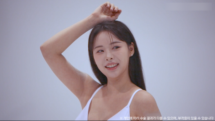 눈밑지방재배치수술 리얼후기 2탄｜수술 한달 후 경과확인! 관련 이미지 14