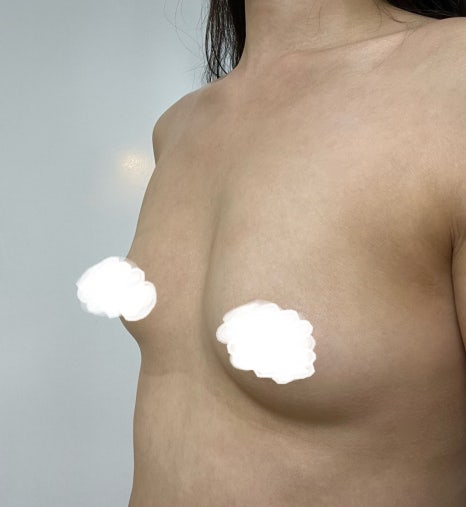 가슴지방이식 지방흡입 같이 하면 어떤 점이 달라질까요 관련 이미지 3