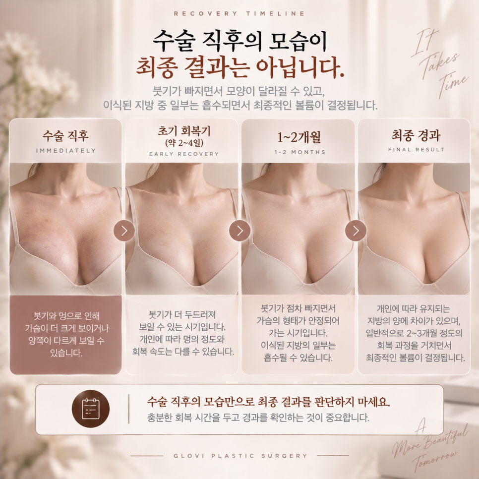 가슴지방이식 전후, 결과보다 관련 이미지 6