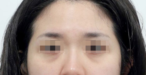 When Can You Return to Work, Exercise, and Wash Your Face After Lower-Eyelid Fat Repositioning? image 6