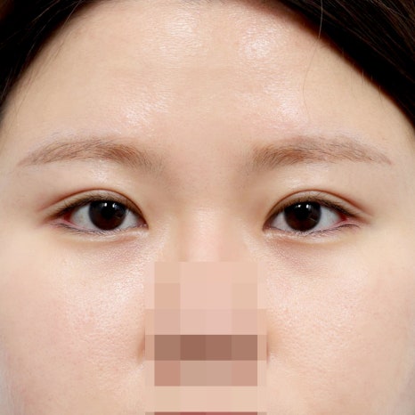 압구정 쌍수, 내 눈에 맞는 수술법 선택 가이드 관련 이미지 5